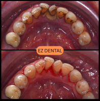 Scaling and Polishing
