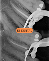 Root Canal Treatment