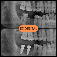 Dental Implant