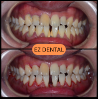 Scaling and Polishing