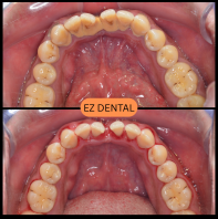 Scaling and Polishing