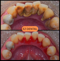 Scaling and Polishing