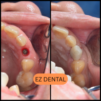Dental Implant