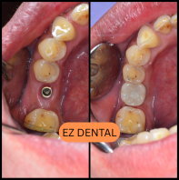 Dental Implant