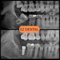 Dental Implant