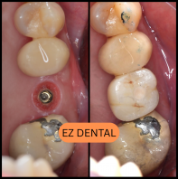 Dental Implant