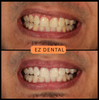 Teeth Whitening