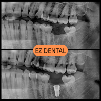 Dental Implant