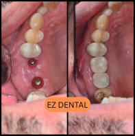Dental Implant