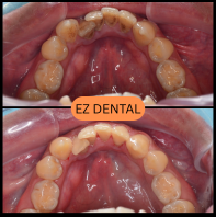 Scaling and Polishing