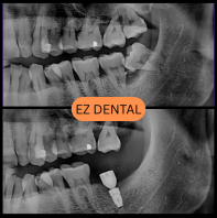 Dental Implant