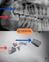 Wisdom Tooth Surgery