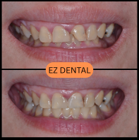 Composite Fillings