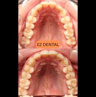 Braces