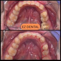 Scaling and Polishing