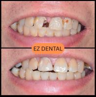 Composite Fillings