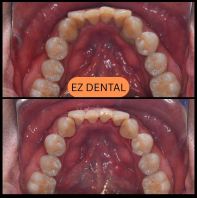 Scaling and Polishing