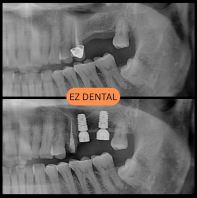 Dental Implant