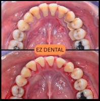 Scaling and Polishing