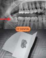 Wisdom Tooth Surgery