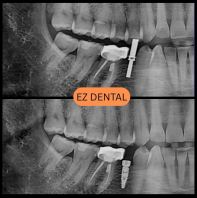 Dental Implant