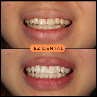 Teeth Whitening
