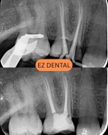 Root Canal Treatment