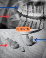 Wisdom Tooth Surgery