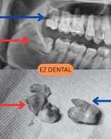 Wisdom Tooth Surgery
