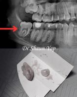 Wisdom Tooth Surgery