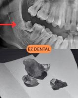Wisdom Tooth Surgery