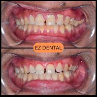 Scaling and Polishing