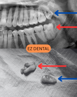 Wisdom Tooth Surgery