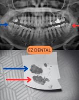 Wisdom Tooth Surgery