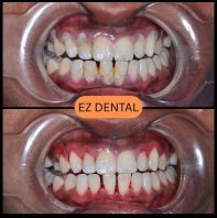 Scaling and Polishing