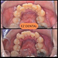 Scaling and Polishing