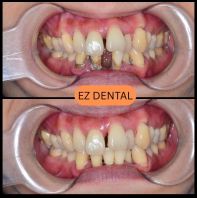 Scaling and Polishing