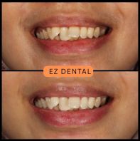 Teeth Whitening