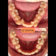 Braces