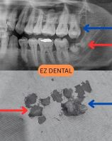 Wisdom Tooth Surgery