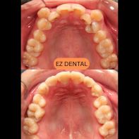 Braces