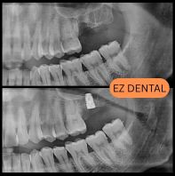 Dental Implant