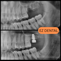 Dental Implant