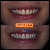 Teeth Whitening