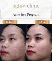 Acne Free Program