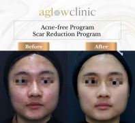 Acne Free Program
