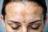 Pigmentation - Melasma Treatment