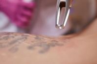 Tattoo Removal
