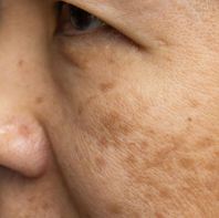 Rawatan Melasma (Jeragat)