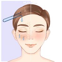 Rawatan Chemical Peel
